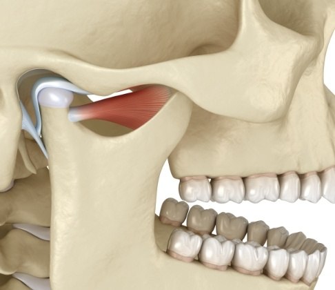 Animated jaw and skull bone showing the source of T M J dysfunction