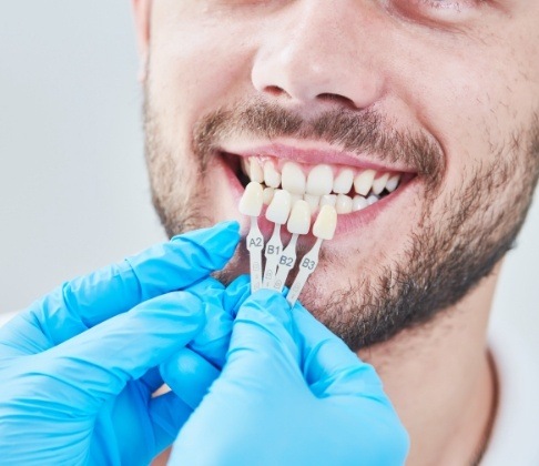 Man's smile compared with porcelain veneer color chart