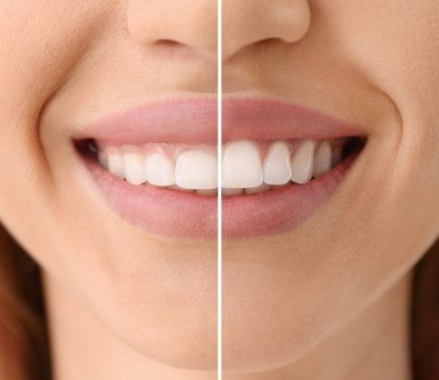 Smile before and after gum recontouring