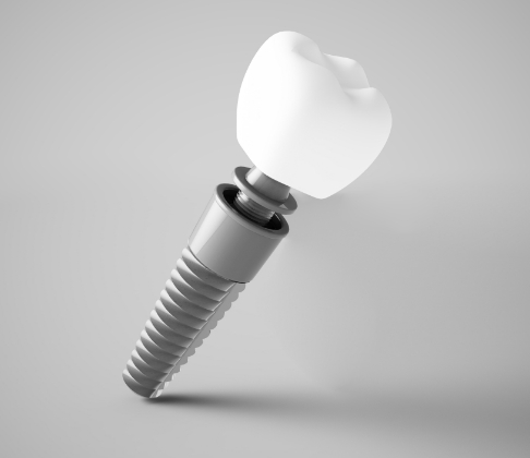 Animated dental implant supported dental crown