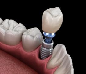 Animated smile during dental implant supported dental crown placement