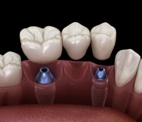 Animated smile during dental implant supported fixed bridge placement