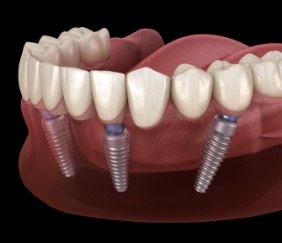 Animated smile during dental implant supported denture placement