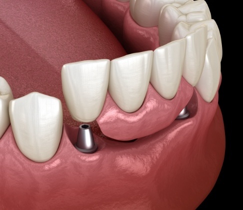 Animated smile during dental implant supported fixed bridge placement