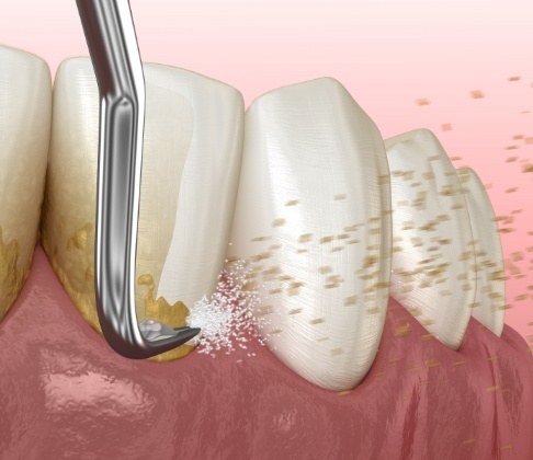 Animated smile during scaling and root planing treatment