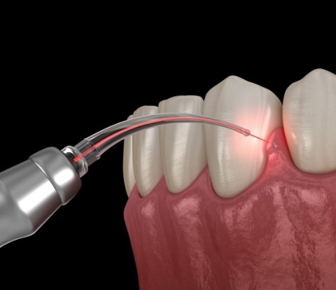 Animated smile during laser periodontal therapy