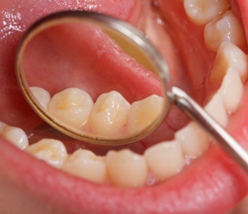 Dentist examining smile after tooth colored filling restoration