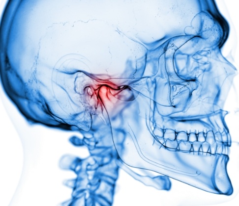 3 D image of jaw in need of equilibration and occlusal adjustment