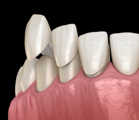 Animated smile during porcelain veneer placement