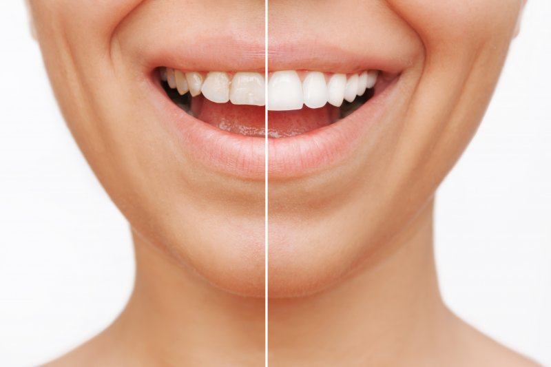 Cropped shot of a woman before and after veneers