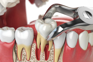 Illustration of a tooth being extracted with forceps