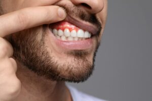 Man showing bump on gums. 