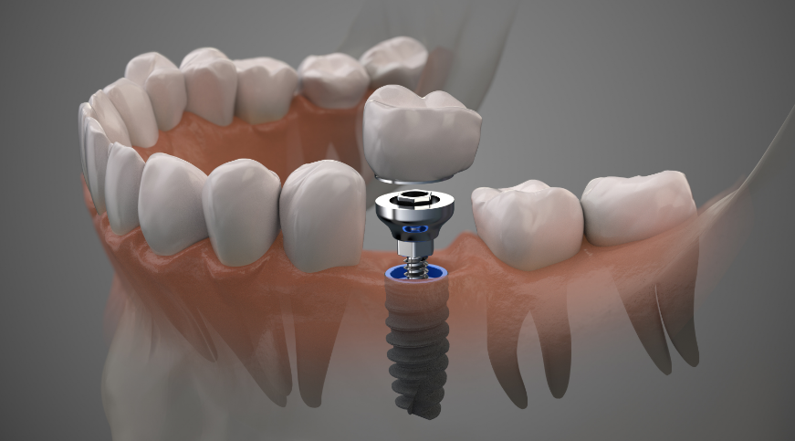 3D image of a dental implant