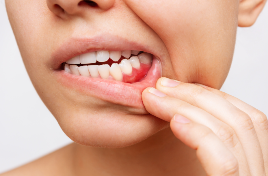 Woman pulling down lip to show gums